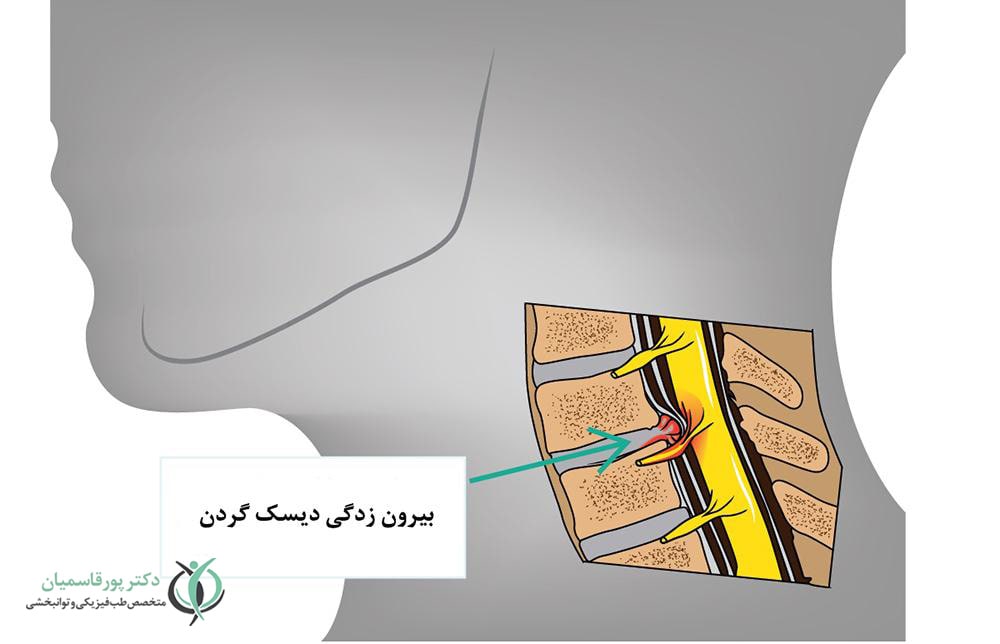 برآمدگی دیسک یا فتق دیسک