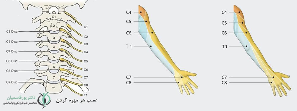 علائم دیسک گردن بر اساس محل بیرون‌زدگی دیسک