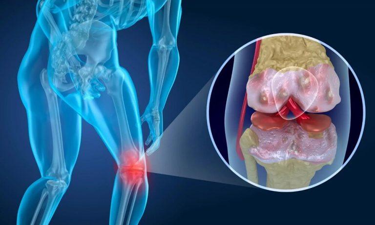 آیا آرتروز زانو قابل درمان و پیشگیری است؟ بررسی علائم و علل ابتلا