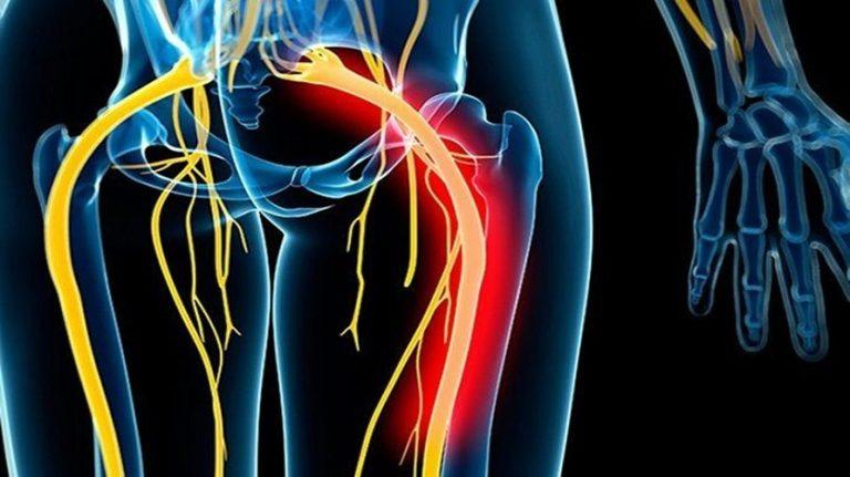 نگاهی به سیاتیک، علائم، درمان‌ها و روش‌های مراقبت و پیشگیری