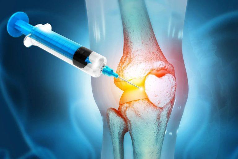 پی آر پی (PRP) زانو چقدر در تسکین درد موثر است؟ چگونه انجام می‌شود؟
