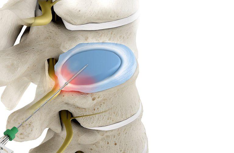 جراحی لیزر دیسک کمر چیست؟ درمان فتق دیسک با آن ممکن است؟