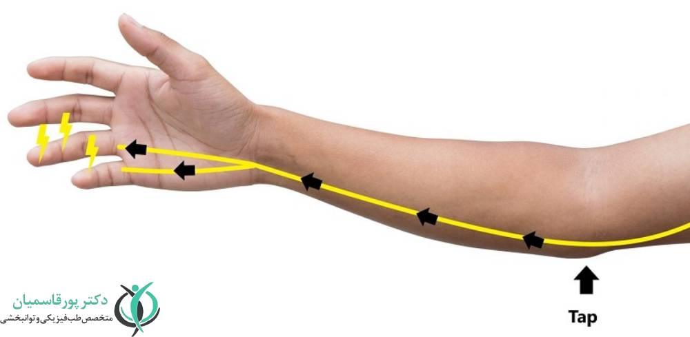 سندرم تونل کوبیتال