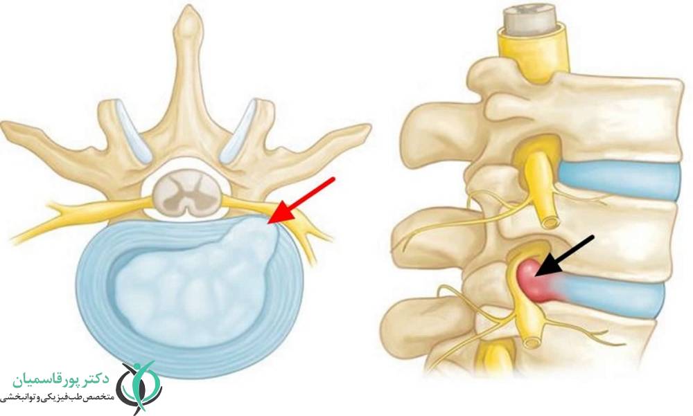 تحت فشار بودن عصب یا رادیکولوپاتی گردن 