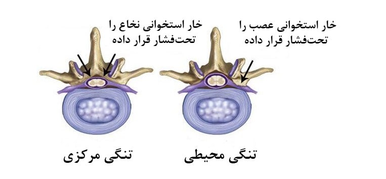 انواع تنگی کانال نخاعی