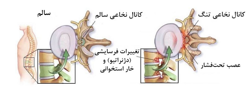 تنگی کانال نخاعی چیست؟ 