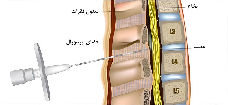 تزریق اپیدورال کورتیزون برای درمان تنگی کانال نخاعی 