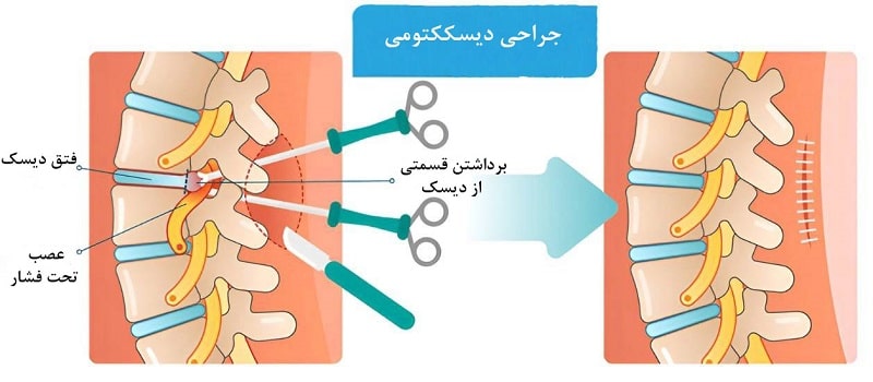 درمان تنگی کانال نخاعی با جراحی 