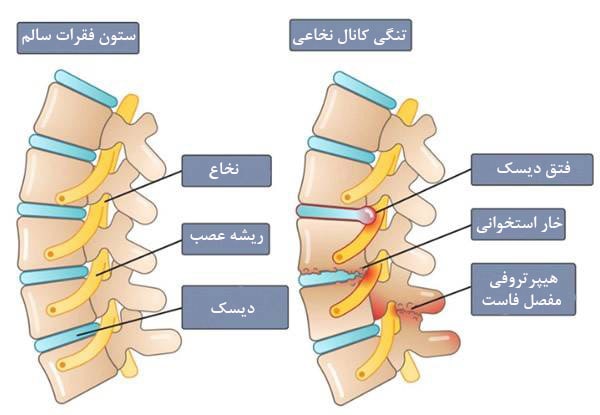 علل تنگی کانال نخاعی