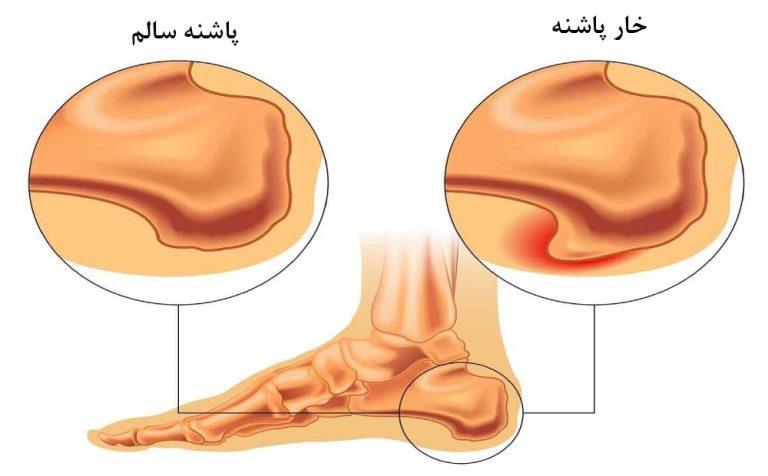 چگونه با خار پاشنه مقابله کنیم؟
