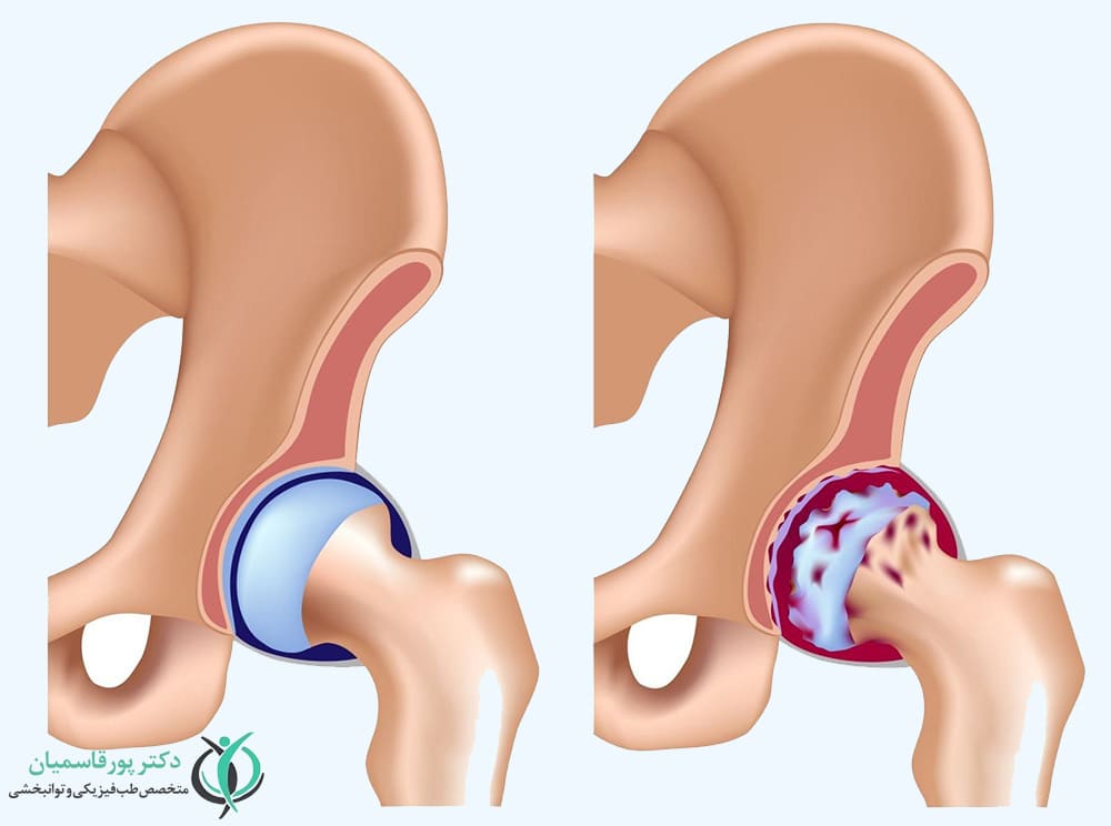 آرتزوز لگن در اثر آسیب غضروف