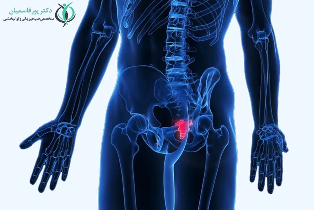 آسیب دنبالچه در اثر زایمان یا نشستن زیاد باعث درد دنبالچه یا لگن می‌شود