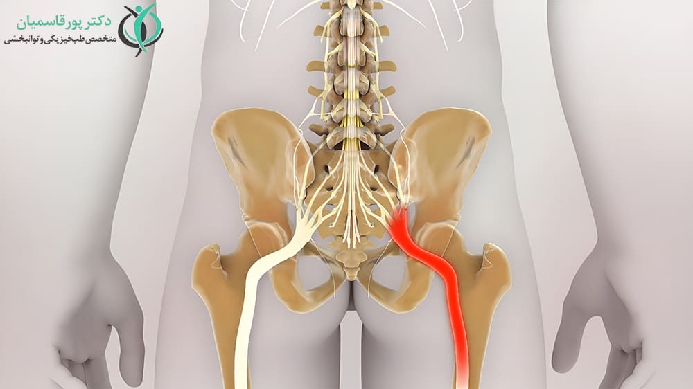 سیاتیک علت درد لگن و باسن
