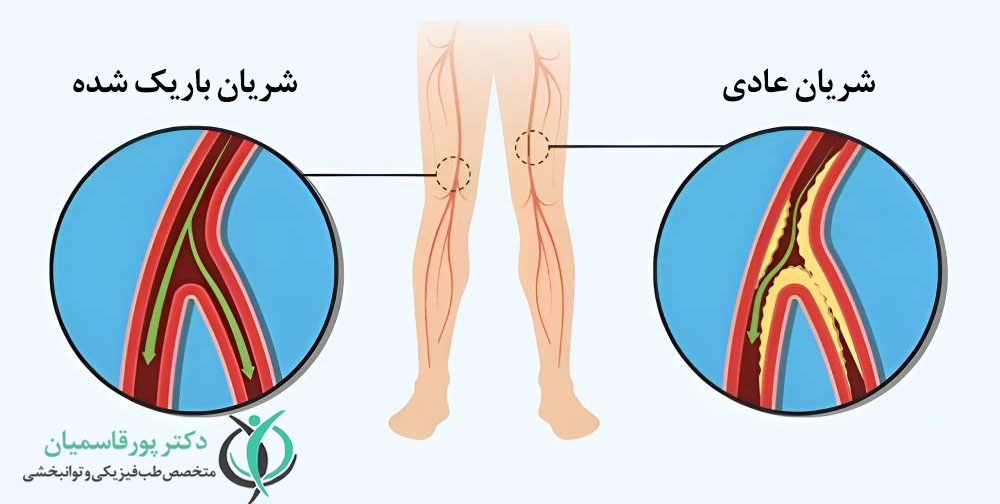 بیماری شریان محیطی از علل داغی کف پا 