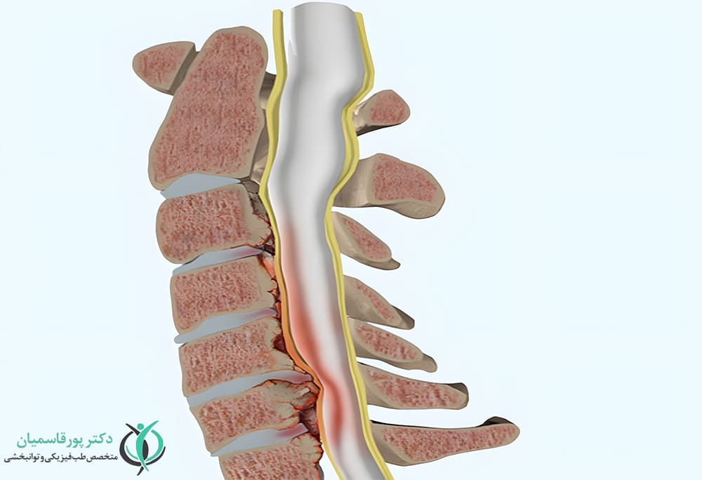 تنگی کانال نخاعی علت درد لگن و باسن