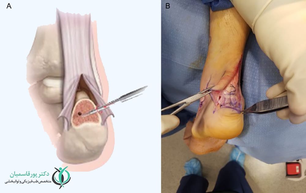 جراحی برای درمان درد پاشنه پا