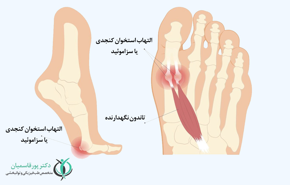 التهاب استخوان کنجدی یا سزاموئید 