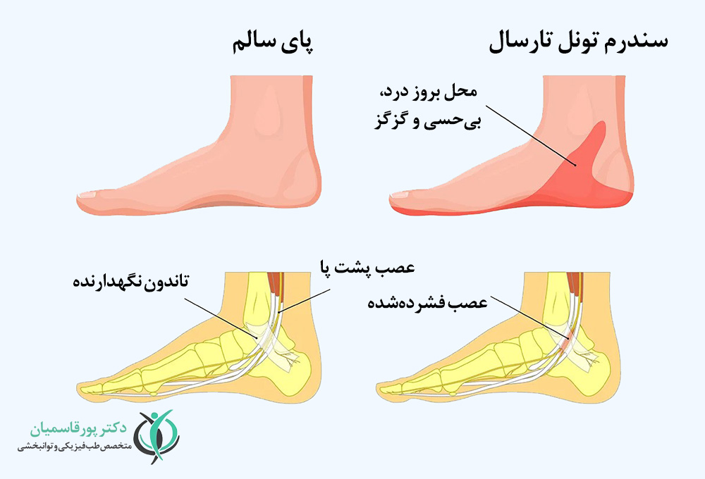 سندروم تونل تارسال