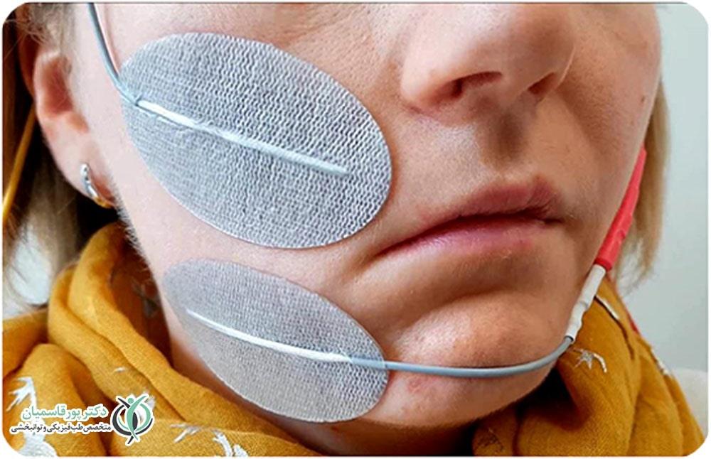 درمان فلج صورت یا بلز پالسی