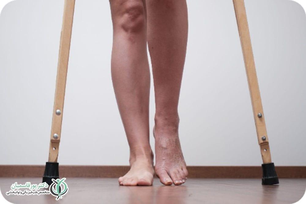 درمان ضعف عضلانی اندامها