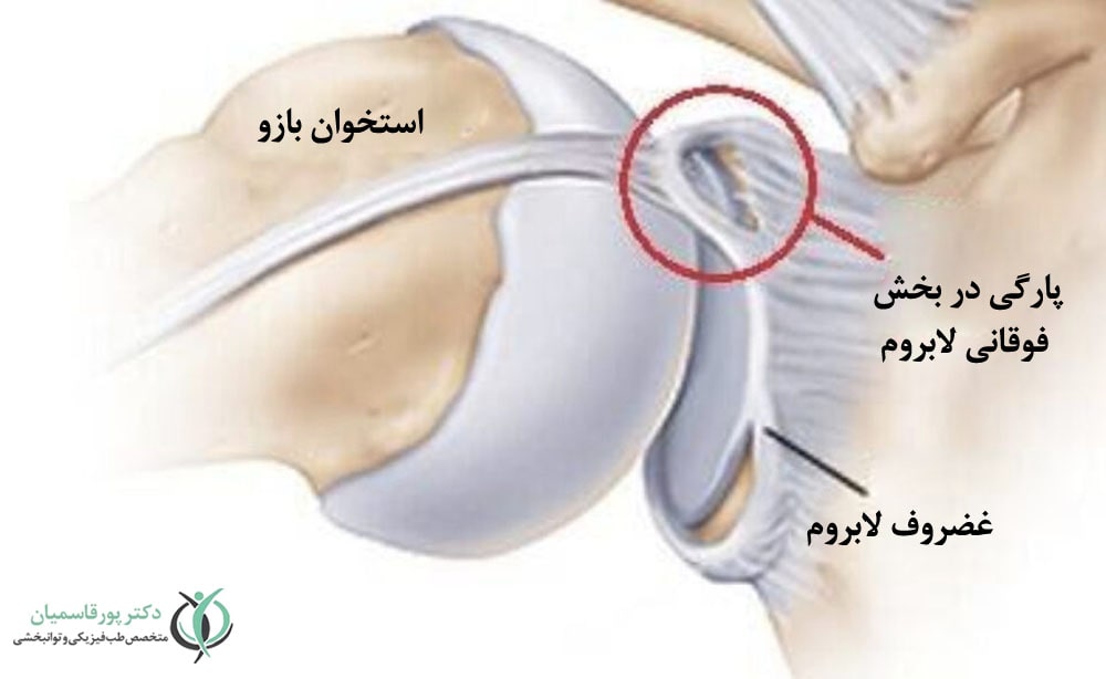 آسیبهای غضروفی