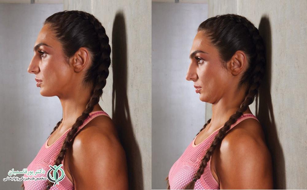  کشش چانه، برای ایجاد یک کشش مناسب در ناحیه گردن