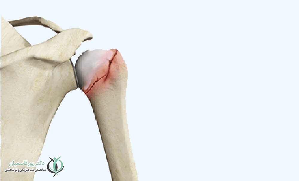 کارایی بالای درمان با پی آر پی