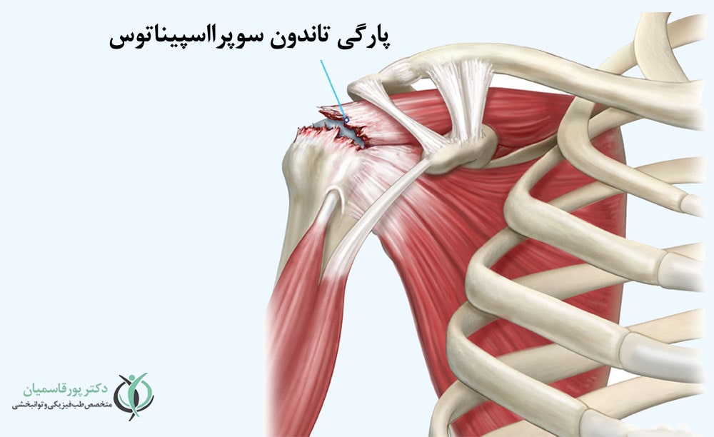 پارگیهای بزرگ تاندونی