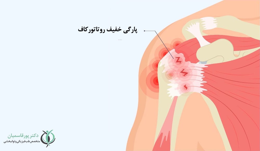 پارگی خفیف تاندون