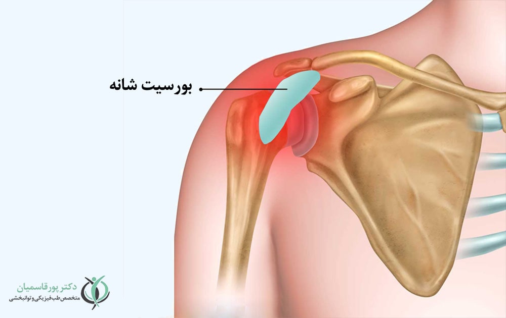 بورسیت شانه