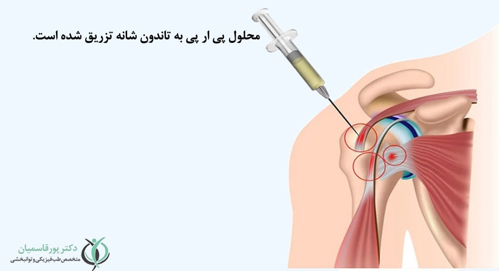 محلول پی آر پی به تاندون شانه تزریق شده است