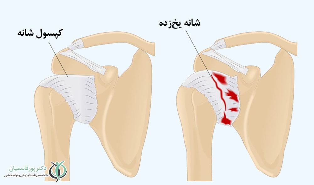 فروزن شولدر
