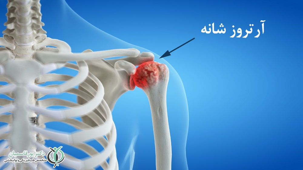 آرتروز شانه
