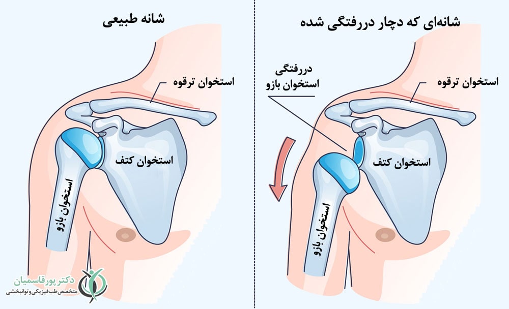 دررفتگی شانه 