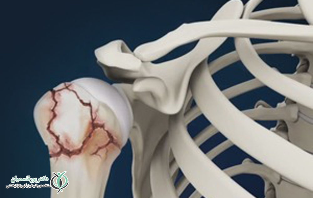 شکستگی شانه 