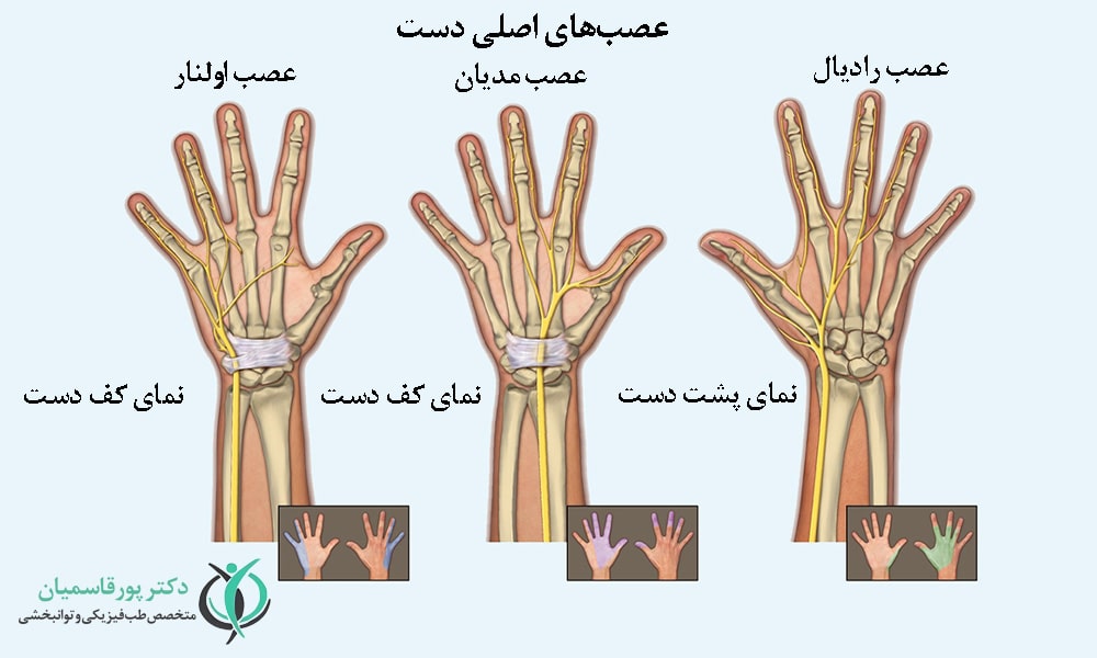 گیرافتادگی عصب‌های داخل دست
