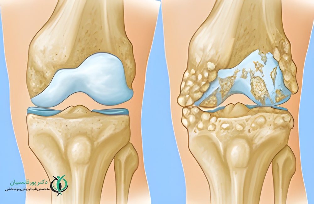 آرتروز زانو