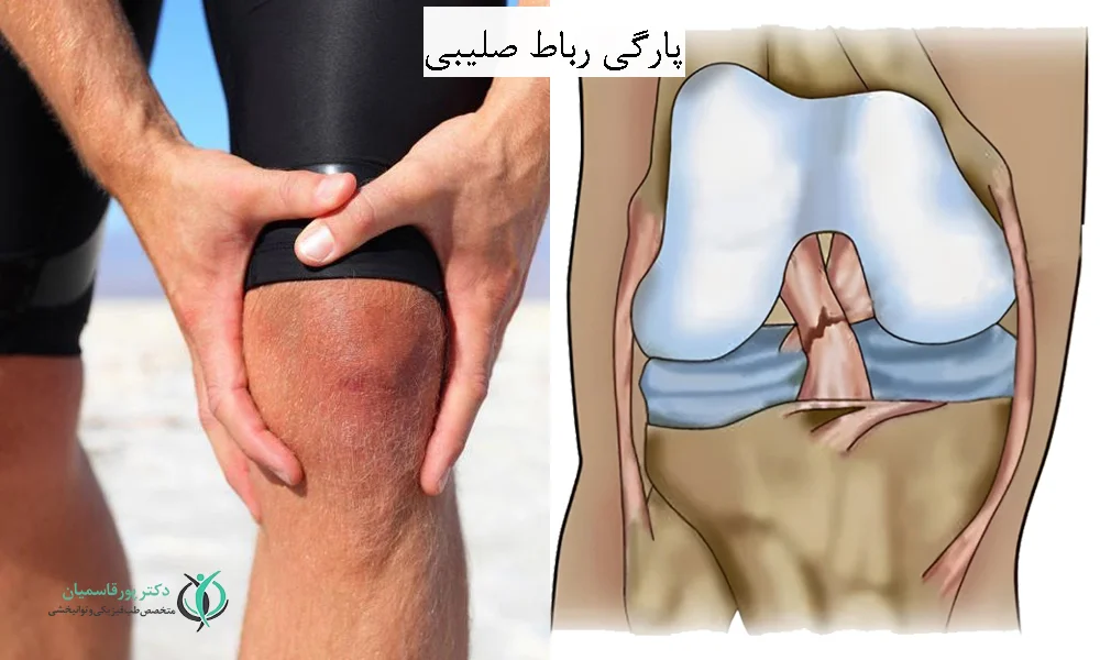 پارگی رباط صلیبی