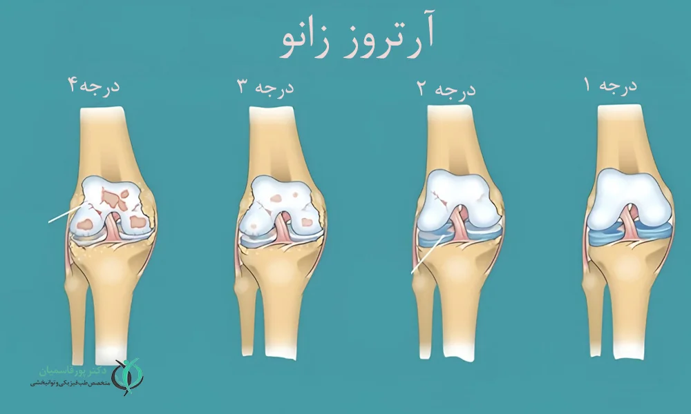 آرتروز زانو