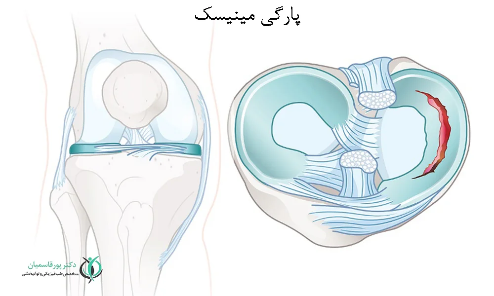 پارگی مینیسک