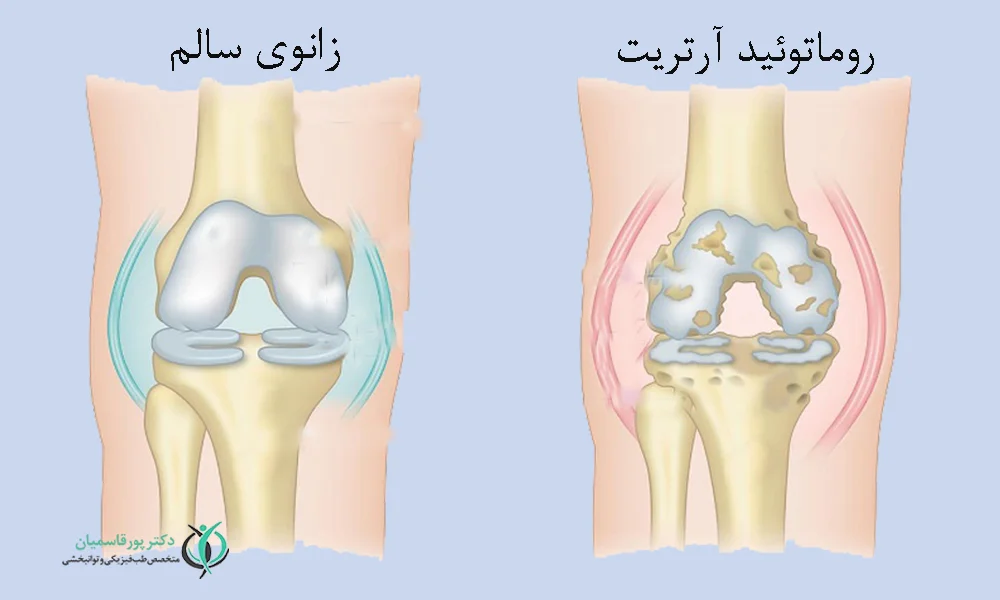 آرتریت روماتوئید