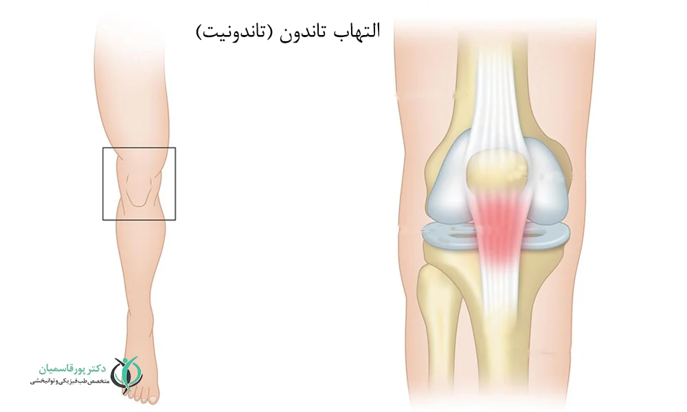 التهاب تاندون